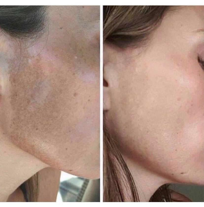 Vitamin C Facial Peel and Neutralizer
