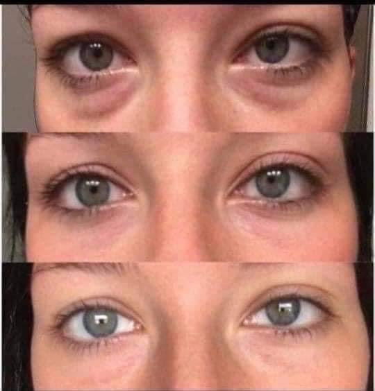 AgeLoc® IdealEyes®