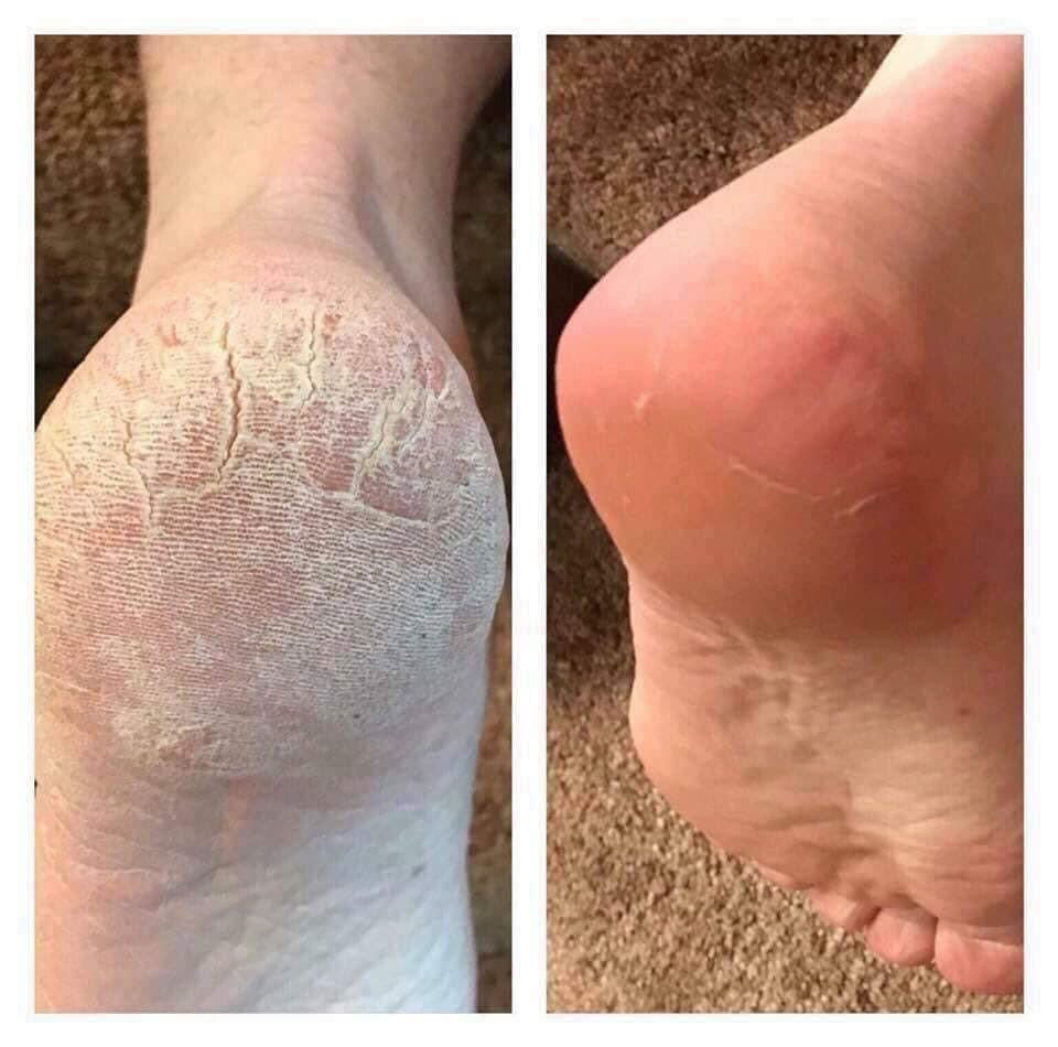 Epoch® Sole Solution® Foot Treatment