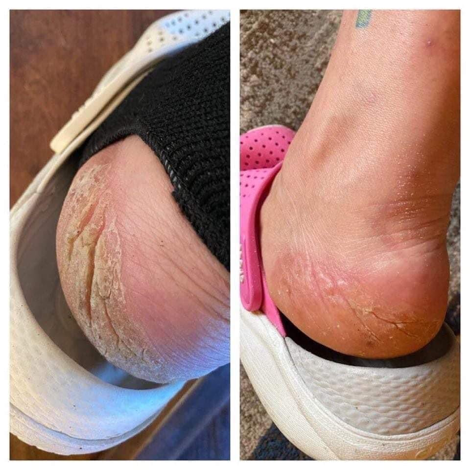 Epoch® Sole Solution® Foot Treatment